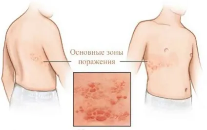 Оперізуючий герпес симптоми і лікування у дорослих фото (симптоми) Оперізуючий герпес симптоми і лікування у дорослих фото