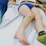 Основні ознаки травматичного вивиху в суглобі (Вивих кисті руки) Основні ознаки травматичного вивиху в суглобі