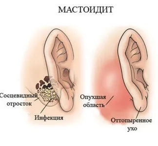 Ускладнення після середнього отиту у дітей і дорослих (ускладнення) Ускладнення після середнього отиту у дітей і дорослих