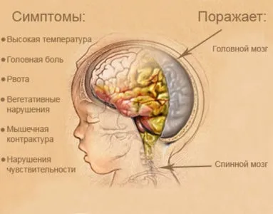 Ускладнення після середнього отиту у дітей і дорослих (ускладнення) Ускладнення після середнього отиту у дітей і дорослих