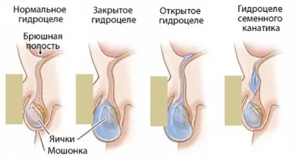 Пухлина яєчка у чоловіків фото, стадії, симптоми і лікування (яєчка) Пухлина яєчка у чоловіків фото, стадії, симптоми і лікування
