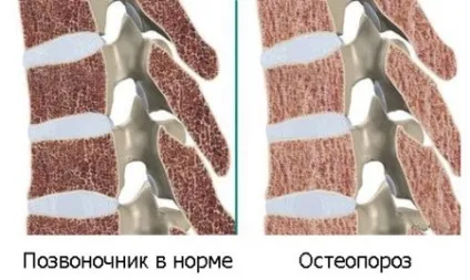 Остеопороз у дітей (ювеніальний) причини, симптоми, лікування