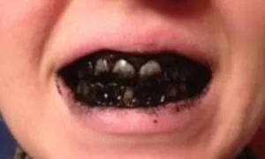 Відбілювання зубів активованим вугіллям як провести процедуру, чи можна, відгуки