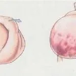 Перелом тазу у собаки лікування в домашніх умовах, чи буде вона ходити, наслідки, симптоми, (буде) Перелом тазу у собаки лікування в домашніх умовах, чи буде вона ходити, наслідки, симптоми,