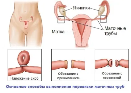 Перев'язка маткових труб - плюси і мінуси (труб) Перев'язка маткових труб - плюси і мінуси