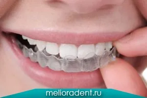 Пластинки для виправлення прикусу - Меліора дент