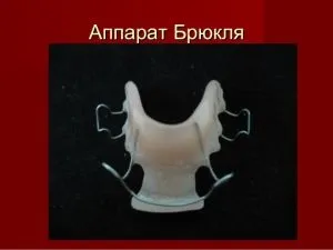Пластини для вирівнювання зубів і виправлення прикусу у дітей різновиди, особливості, відгуки (пластини на зуби дітям) Пластини для вирівнювання зубів і виправлення прикусу у дітей різновиди, особливості, відгуки