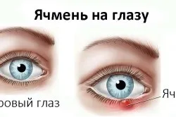Чому болять повіки очей (здорові очі) Чому болять повіки очей