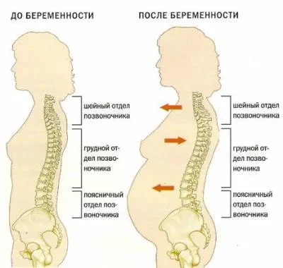 Чому поперек болить вранці, після сну, у жінок і чоловіків (поперек) Чому поперек болить вранці, після сну, у жінок і чоловіків