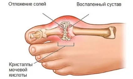 Подагра ознаки і лікування, симптоми, що за хвороба, як лікувати подагру (ознаки) Подагра ознаки і лікування, симптоми, що за хвороба, як лікувати подагру
