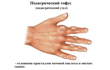 Подагра ознаки і лікування, симптоми, що за хвороба, як лікувати подагру (симптоми) Подагра ознаки і лікування, симптоми, що за хвороба, як лікувати подагру