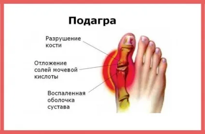 Подагра ознаки і лікування, симптоми, що за хвороба, як лікувати подагру (подагра) Подагра ознаки і лікування, симптоми, що за хвороба, як лікувати подагру