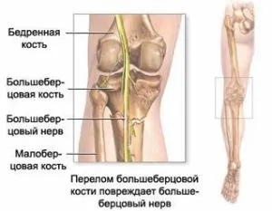 Поразка великогомілкової нерва (невропатія, неврит) симптоми, лікування (нерва) Поразка великогомілкової нерва (невропатія, неврит) симптоми, лікування