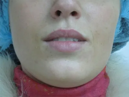 Помпа для збільшення губ (фото) відгуки, відео як користуватися своїми руками, де купити по найкращій (користуватися) Помпа для збільшення губ (фото) відгуки, відео як користуватися своїми руками, де купити по найкращій