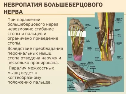 Поразка великогомілкової нерва (невропатія, неврит) симптоми, лікування (нейропатія большеберцового нерва) Поразка великогомілкової нерва (невропатія, неврит) симптоми, лікування