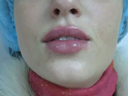 Помпа для збільшення губ (фото) відгуки, відео як користуватися своїми руками, де купити по найкращій (купити) Помпа для збільшення губ (фото) відгуки, відео як користуватися своїми руками, де купити по найкращій