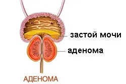 Передміхурова залоза функції, захворювання і методи їх лікування (функції) Передміхурова залоза функції, захворювання і методи їх лікування