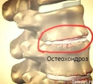 Препарати для лікування остеохондрозу поперекового відділу хребта, призначення лікарів (відділу) Препарати для лікування остеохондрозу поперекового відділу хребта, призначення лікарів