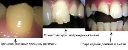 Пошкодження зуба види і що робити (ясна) Пошкодження зуба види і що робити