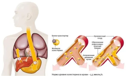Підвищений холестерин і цукровий діабет (Високий холестерин Причини наслідки) Підвищений холестерин і цукровий діабет