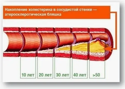 Підвищений холестерин і цукровий діабет (наслідки підвищеного холестерину) Підвищений холестерин і цукровий діабет