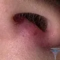 Прищ на носі причини, значення, фото, що робити (причини) Прищ на носі причини, значення, фото, що робити