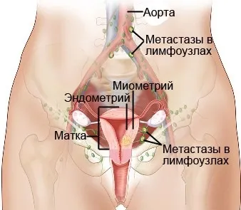 Причини раку шийки матки
