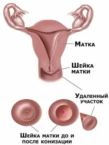 Причини раку шийки матки