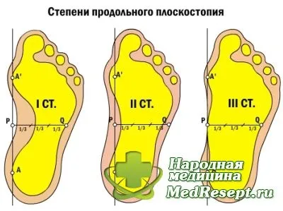 Причини, симптоми і лікування плоскостопості - медичні поради (симптоми) Причини, симптоми і лікування плоскостопості - медичні поради