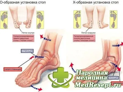 Причини, симптоми і лікування плоскостопості - медичні поради (симптоми) Причини, симптоми і лікування плоскостопості - медичні поради