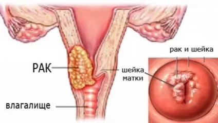 Причини раку шийки матки