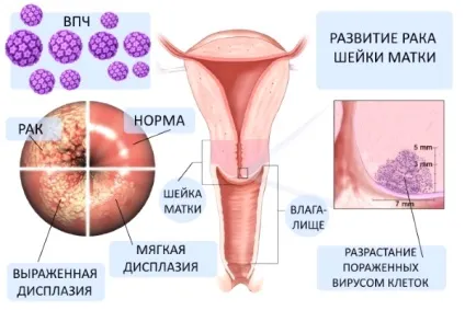 Причини раку шийки матки