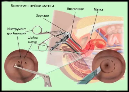 Причини раку шийки матки