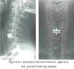 Протез міжхребцевого диска