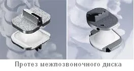 Протез міжхребцевого диска