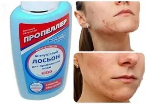 Пропелер від прищів наноситься на обличчя, склад, застосування засобів (особа) Пропелер від прищів наноситься на обличчя, склад, застосування засобів