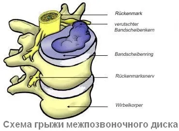 Протез міжхребцевого диска