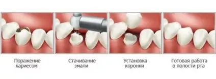 Протезування передніх верхніх зубів