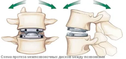 Протез міжхребцевого диска