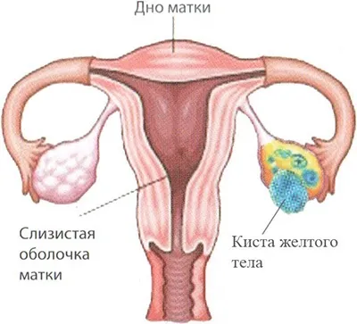 Розрив кісти яєчника симптоми і лікування, що робити і наслідки у жінок (розрив) Розрив кісти яєчника симптоми і лікування, що робити і наслідки у жінок