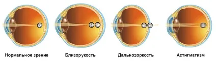 Різниця між астигматизмом і короткозорістю, про хвороби очей (різниця) Різниця між астигматизмом і короткозорістю, про хвороби очей