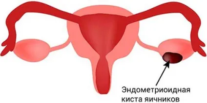 Розрив кісти яєчника симптоми і лікування, що робити і наслідки у жінок (розрив) Розрив кісти яєчника симптоми і лікування, що робити і наслідки у жінок