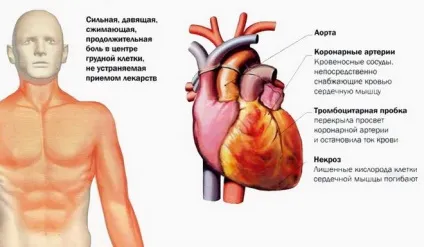 Реанімаційні заходи при ускладненнях інфаркту міокарда правила надання допомоги (заходи) Реанімаційні заходи при ускладненнях інфаркту міокарда правила надання допомоги