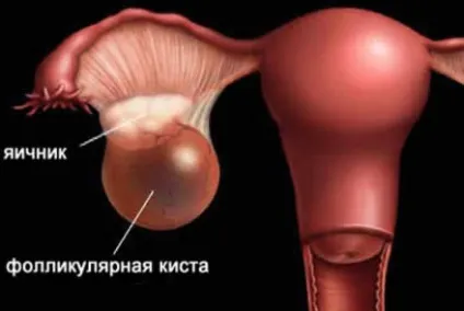 Розрив кісти яєчника симптоми і лікування, що робити і наслідки у жінок (кісти) Розрив кісти яєчника симптоми і лікування, що робити і наслідки у жінок