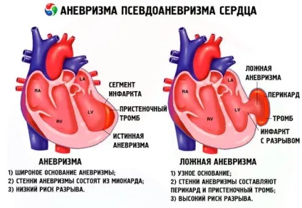 Реанімаційні заходи при ускладненнях інфаркту міокарда правила надання допомоги (заходи) Реанімаційні заходи при ускладненнях інфаркту міокарда правила надання допомоги