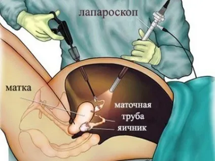 Розрив кісти яєчника симптоми і лікування, що робити і наслідки у жінок (розрив) Розрив кісти яєчника симптоми і лікування, що робити і наслідки у жінок
