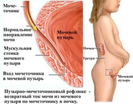 Рефлюкс нирки і сечового міхура у дітей симптоми, лікування
