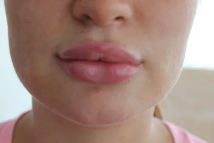 Родимка на підборідді у чоловіків, жінок значення (родимка) Родимка на підборідді у чоловіків, жінок значення