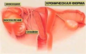 Сальпингоофорит причини і механізм розвитку, основні клінічні симптоми і ознаки, діагностика (причини) Сальпингоофорит причини і механізм розвитку, основні клінічні симптоми і ознаки, діагностика