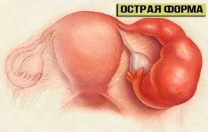 Сальпингоофорит причини і механізм розвитку, основні клінічні симптоми і ознаки, діагностика (сальпінгоофорит) Сальпингоофорит причини і механізм розвитку, основні клінічні симптоми і ознаки, діагностика